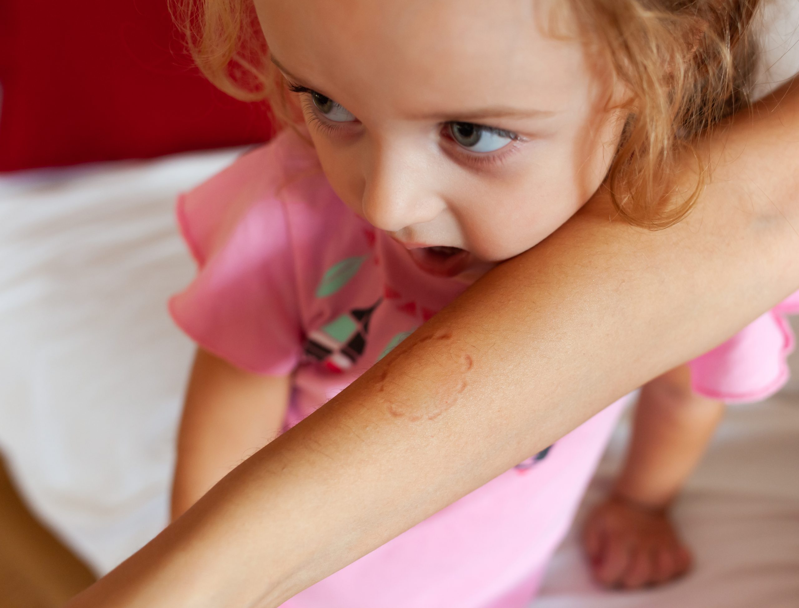 toddler,female,biting,the,arm,of,the,mother.,children,face