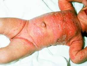 Бебе с себореен дерматит